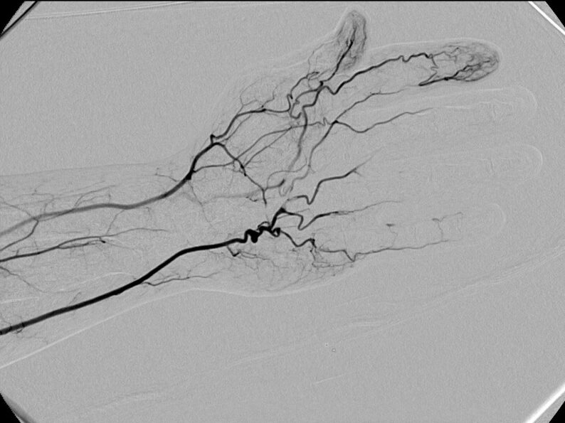 hypothenarhammer syndrome (1)